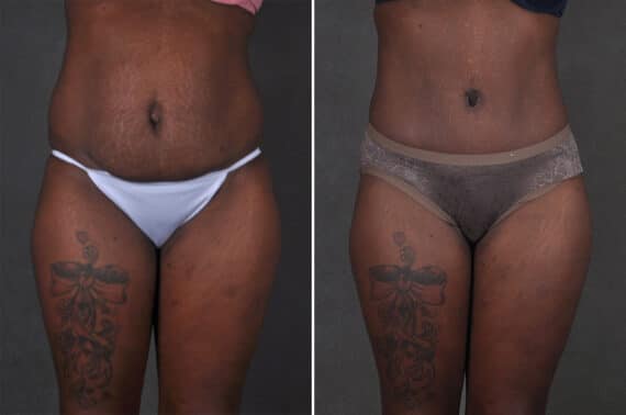Liposuction Before and After Photos in Omaha, NE, Case 21267