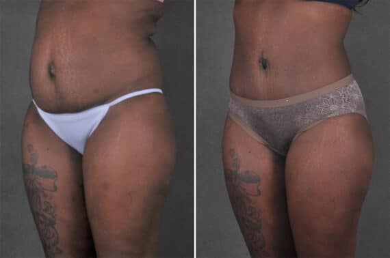 Tummy Tuck Before and After Photos in Omaha, NE, Case 21295