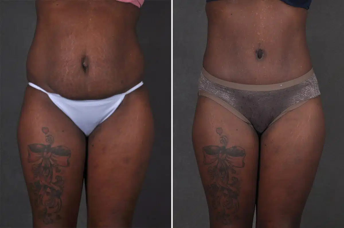 Case 21295, Tummy Tuck Before and After Photos Tummy Tuck Before and After Photos in Omaha, NE, Case 21295