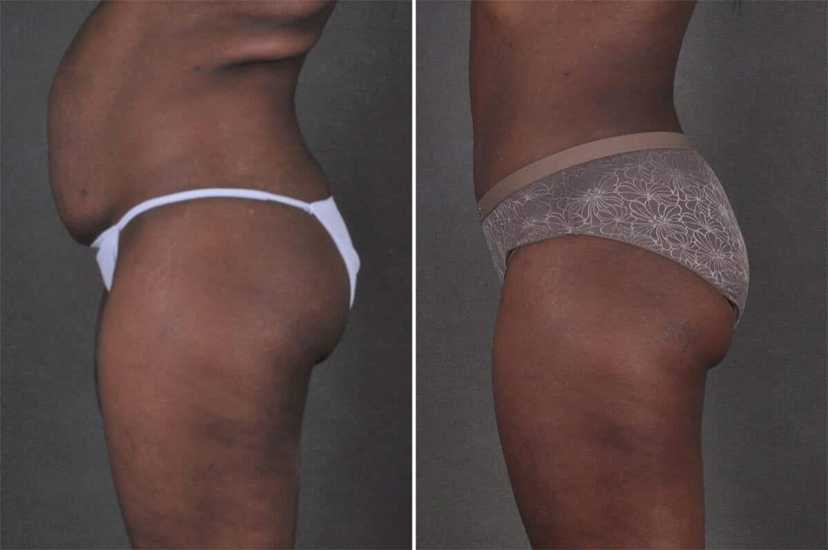 Case 21295, Tummy Tuck Before and After Photos Tummy Tuck Before and After Photos in Omaha, NE, Case 21295