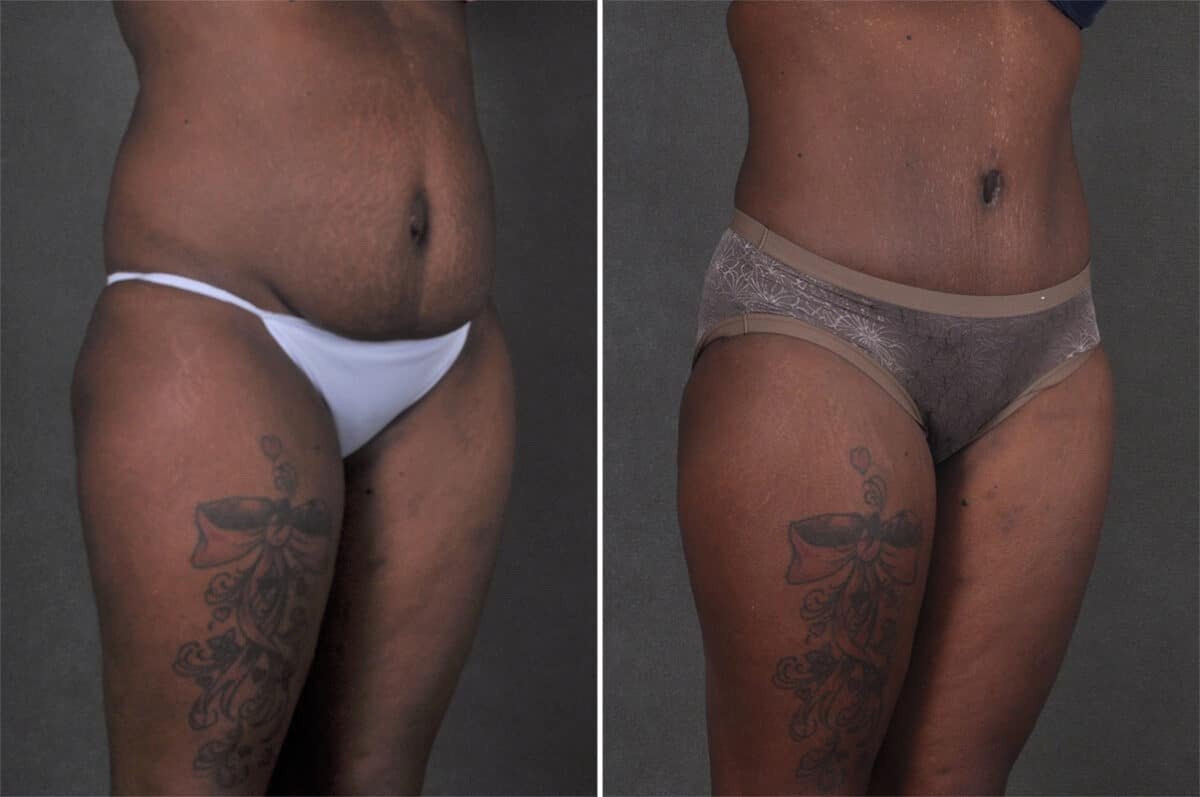 Case 21295, Tummy Tuck Before and After Photos Tummy Tuck Before and After Photos in Omaha, NE, Case 21295