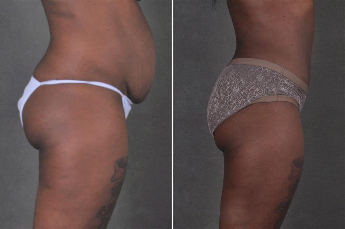 Case 21295, Tummy Tuck Before and After Photos Tummy Tuck Before and After Photos in Omaha, NE, Case 21295
