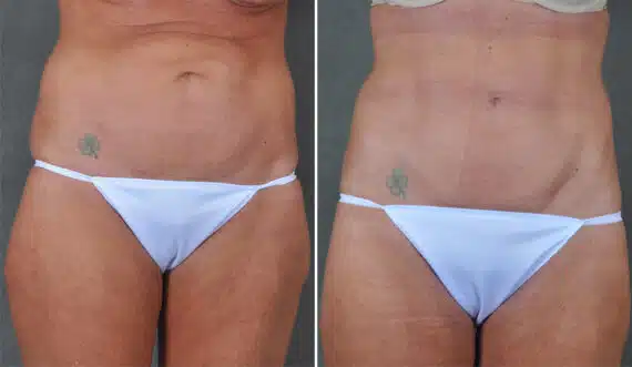 Liposuction Before and After Photos in Omaha, NE, Case 21301