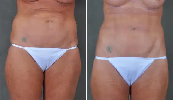 Liposuction Before and After Photos in Omaha, NE, Case 21301