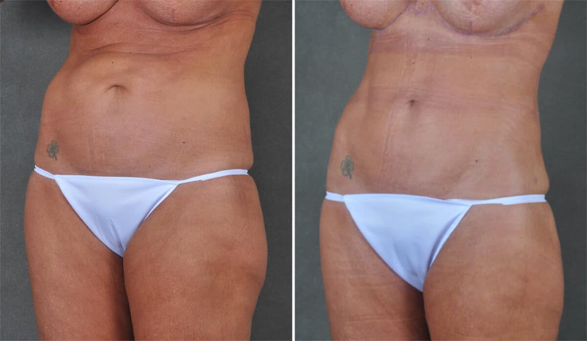 Case 21308, Tummy Tuck Before and After Photos Tummy Tuck Before and After Photos in Omaha, NE, Case 21308