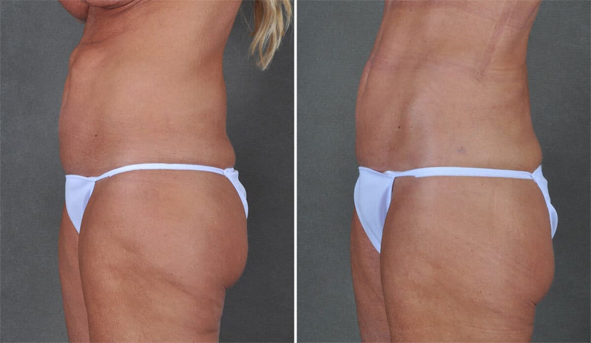 Case 21308, Tummy Tuck Before and After Photos Tummy Tuck Before and After Photos in Omaha, NE, Case 21308