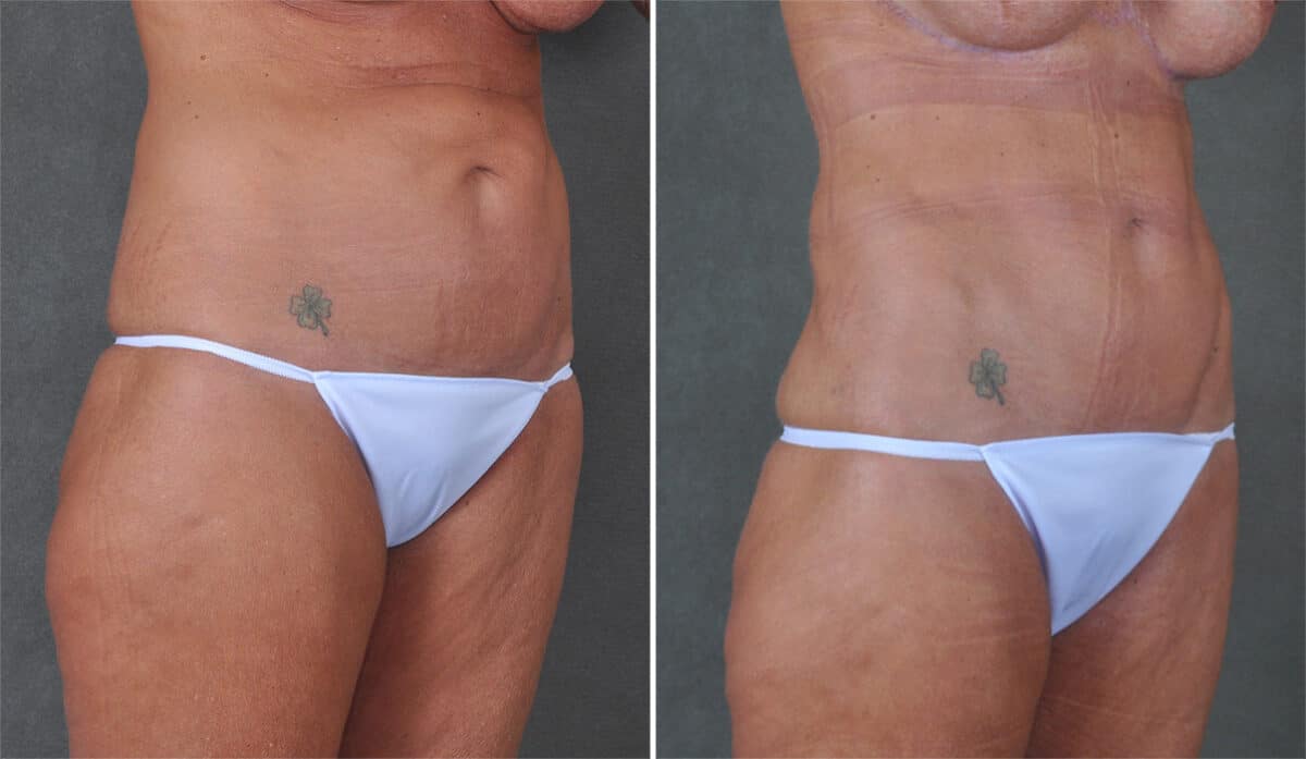 Case 21308, Tummy Tuck Before and After Photos Tummy Tuck Before and After Photos in Omaha, NE, Case 21308