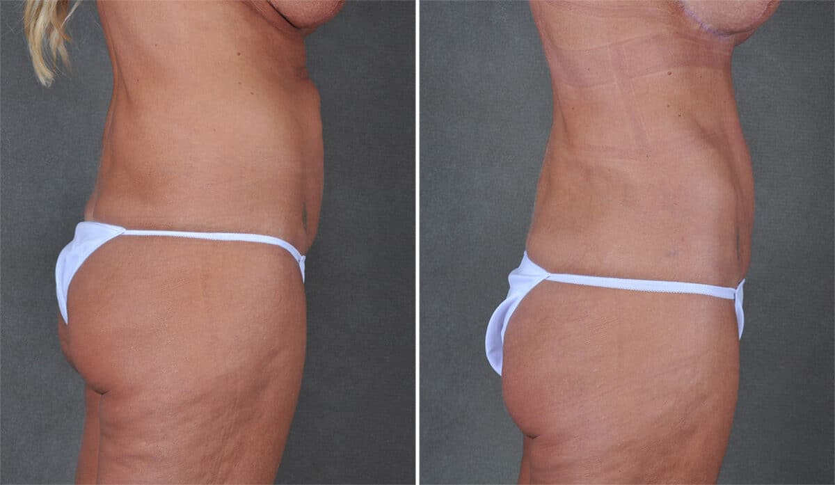 Case 21308, Tummy Tuck Before and After Photos Tummy Tuck Before and After Photos in Omaha, NE, Case 21308