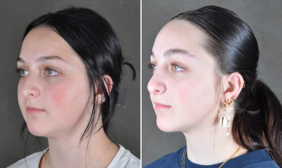 Rhinoplasty Before and After Photos in Omaha, NE, Case 21560