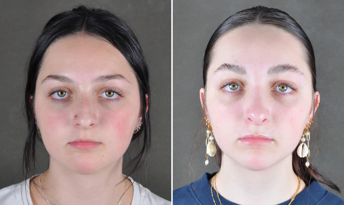 Case 21560, Rhinoplasty Before and After Photos Rhinoplasty Before and After Photos in Omaha, NE, Case 21560