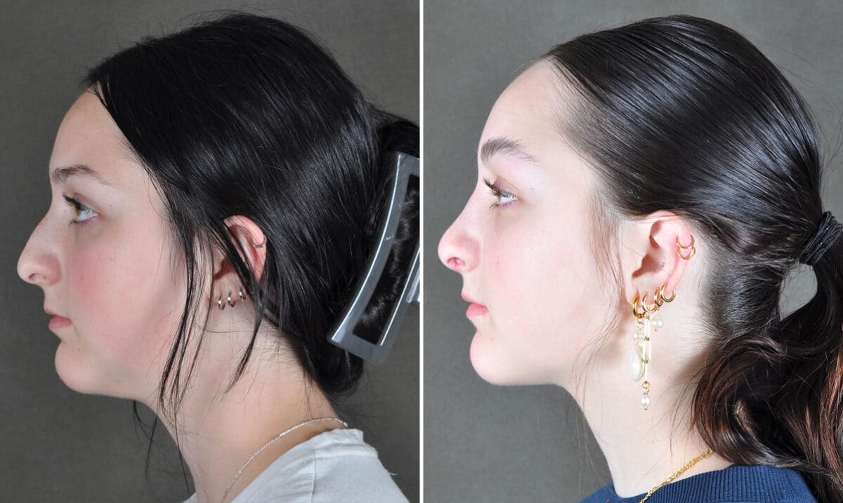 Case 21560, Rhinoplasty Before and After Photos Rhinoplasty Before and After Photos in Omaha, NE, Case 21560