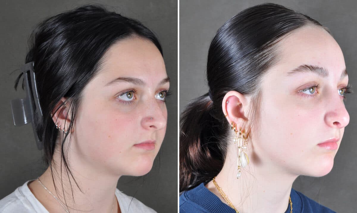 Case 21560, Rhinoplasty Before and After Photos Rhinoplasty Before and After Photos in Omaha, NE, Case 21560