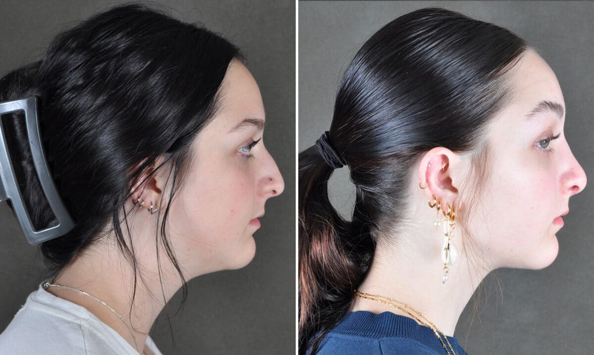 Case 21560, Rhinoplasty Before and After Photos Rhinoplasty Before and After Photos in Omaha, NE, Case 21560