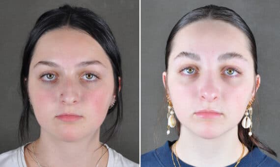 Rhinoplasty Before and After Photos in Omaha, NE, Case 21560
