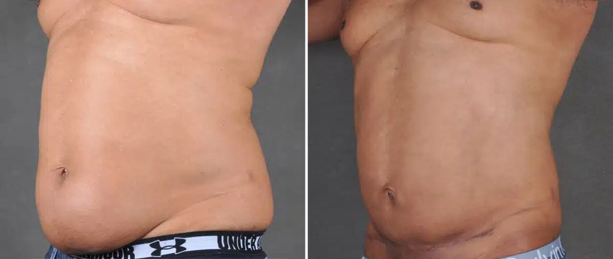 Mini Tummy Tuck Before and After Photos in Omaha, NE, Case 21594