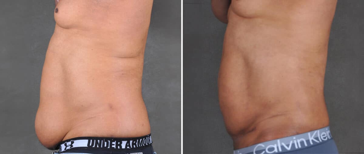 Mini Tummy Tuck Before and After Photos in Omaha, NE, Case 21594