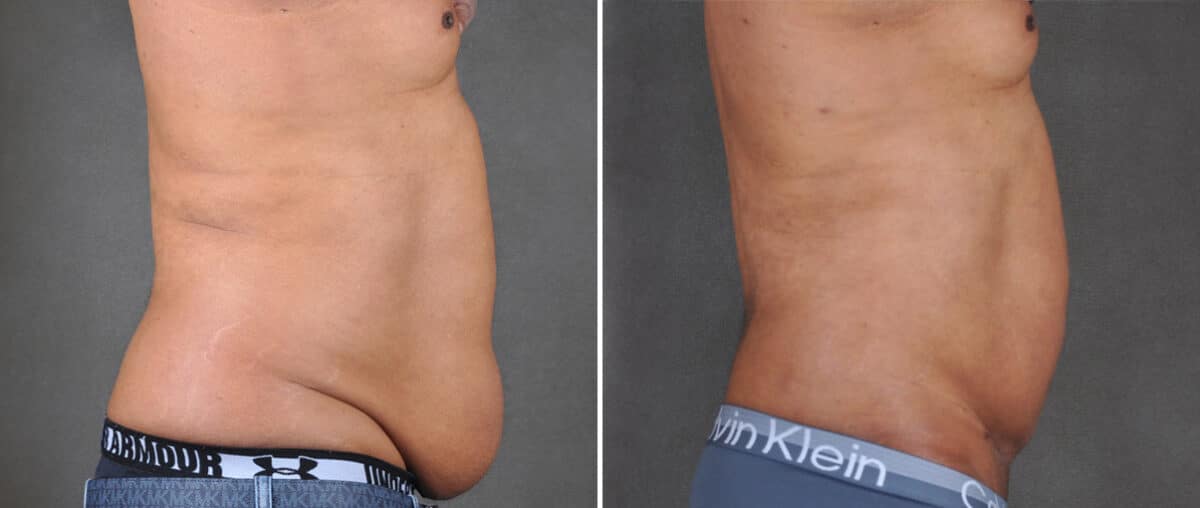 Mini Tummy Tuck Before and After Photos in Omaha, NE, Case 21594