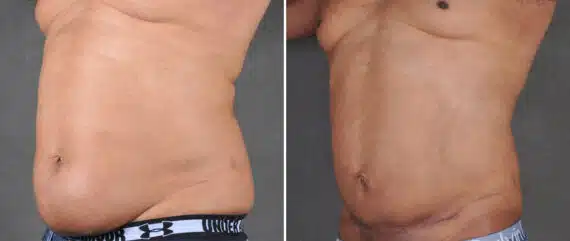 Liposuction Before and After Photos in Omaha, NE, Case 21610