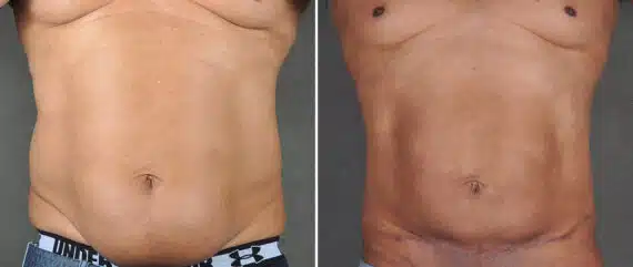 Liposuction Before and After Photos in Omaha, NE, Case 21610