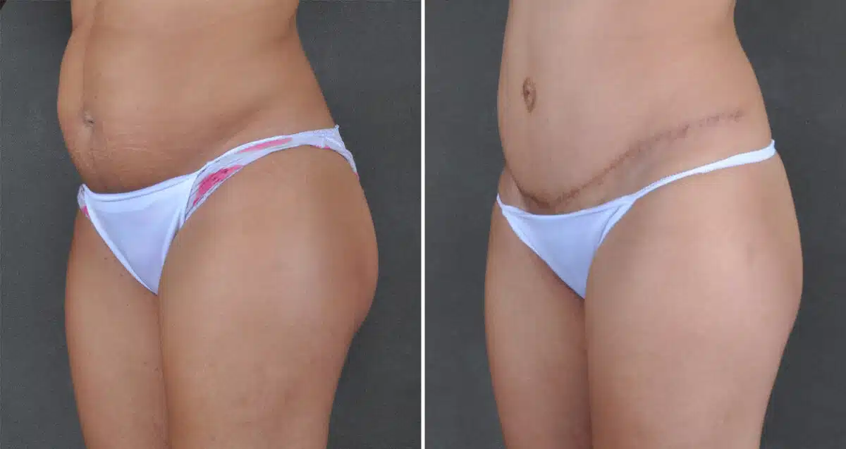 Case 21616, Tummy Tuck Before and After Photos Tummy Tuck Before and After Photos in Omaha, NE, Case 21616