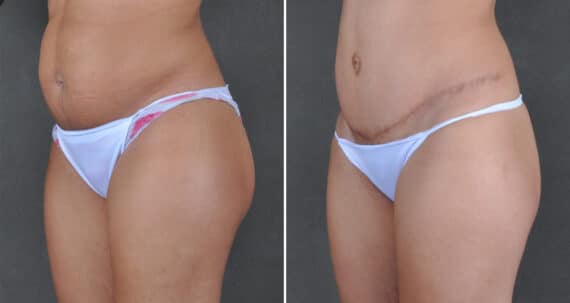 Tummy Tuck Before and After Photos in Omaha, NE, Case 21616