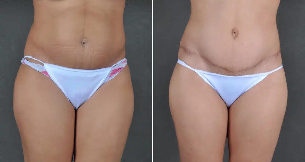Case 21616, Tummy Tuck Before and After Photos Tummy Tuck Before and After Photos in Omaha, NE, Case 21616