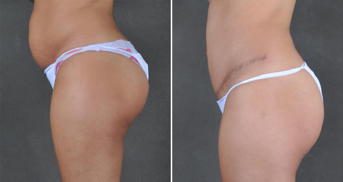 Case 21616, Tummy Tuck Before and After Photos Tummy Tuck Before and After Photos in Omaha, NE, Case 21616