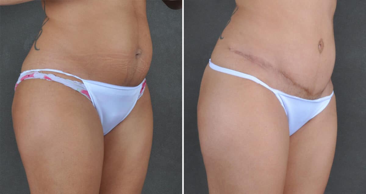 Case 21616, Tummy Tuck Before and After Photos Tummy Tuck Before and After Photos in Omaha, NE, Case 21616