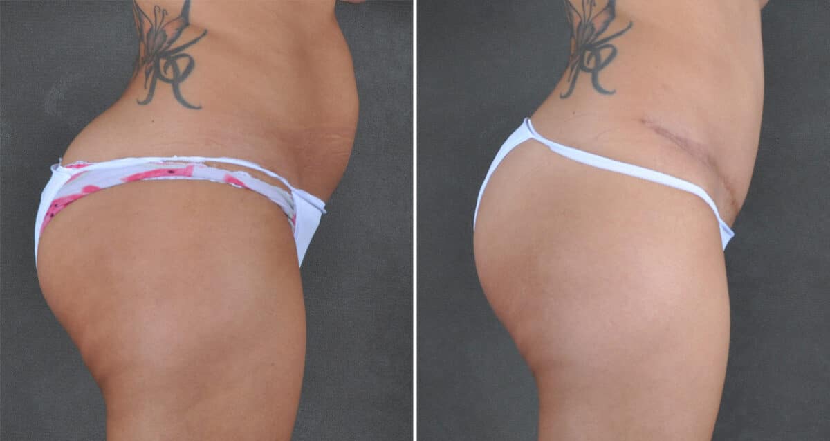 Case 21616, Tummy Tuck Before and After Photos Tummy Tuck Before and After Photos in Omaha, NE, Case 21616