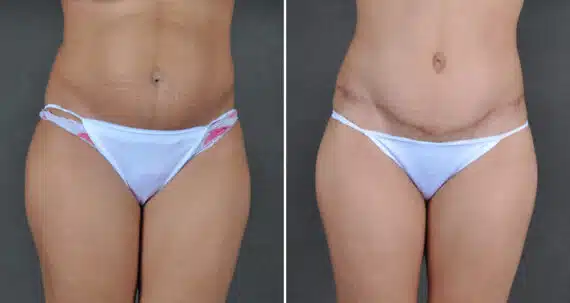 Tummy Tuck Before and After Photos in Omaha, NE, Case 21616