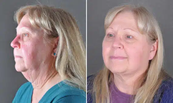 Facelift Before and After Photos in Omaha, NE, Case 21654