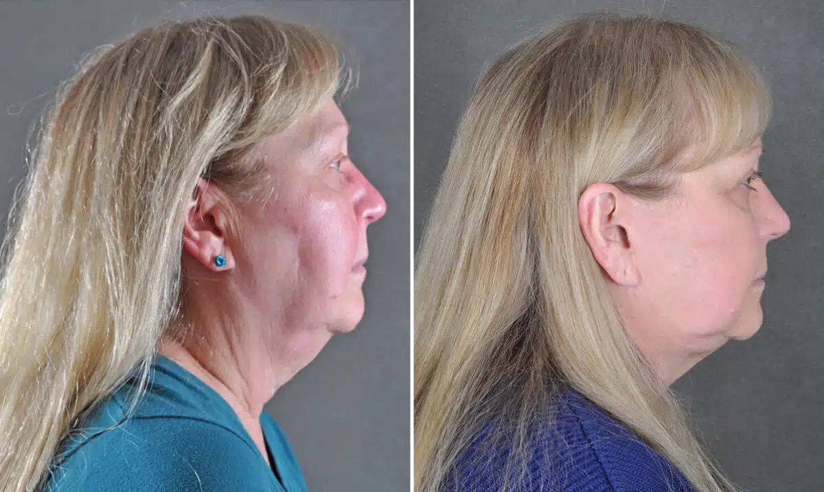 Case 21680, Blepharoplasty Before and After Photos Blepharoplasty Before and After Photos in Omaha, NE, Case 21680