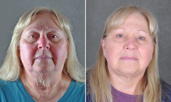 Blepharoplasty Before and After Photos in Omaha, NE, Case 21680
