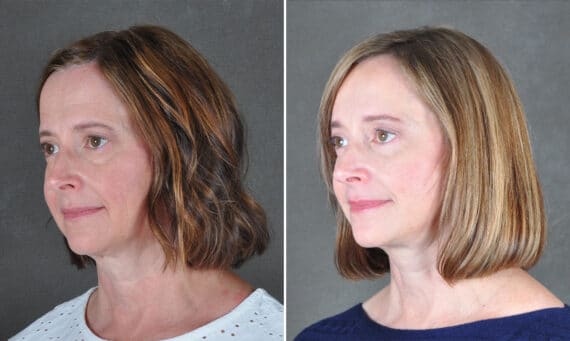 Facelift Before and After Photos in Omaha, NE, Case 21686