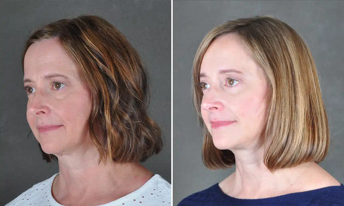 Facelift Before and After Photos in Omaha, NE, Case 21686