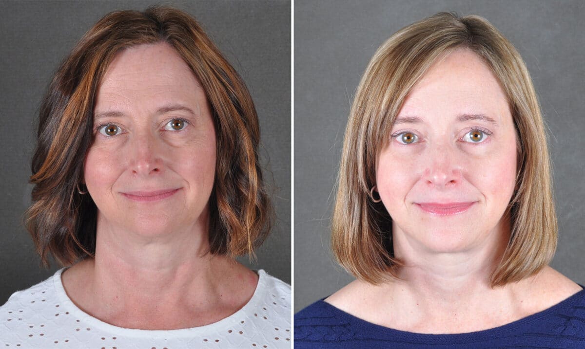 Case 21686, Facelift Before and After Photos Facelift Before and After Photos in Omaha, NE, Case 21686