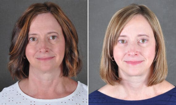 Facelift Before and After Photos in Omaha, NE, Case 21686