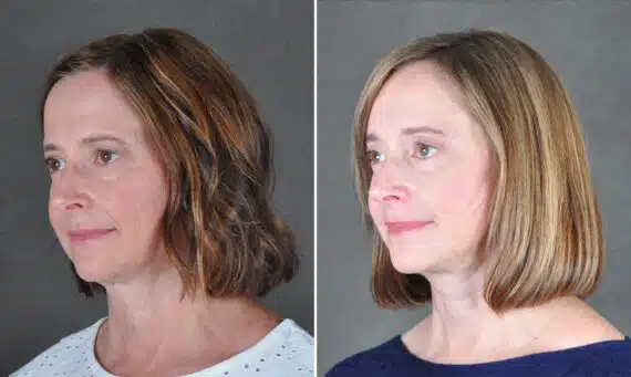Brow Lift Before and After Photos in Omaha, NE, Case 21692