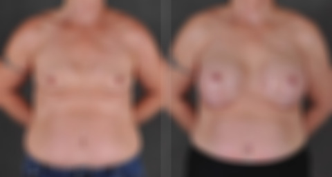 Breast Augmentation Before and After Photos in Omaha, NE, Case 16196