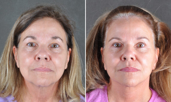 Blepharoplasty Before and After Photos in Omaha, NE, Case 22013
