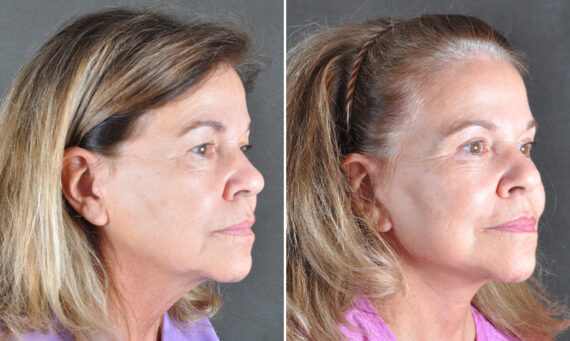 Blepharoplasty Before and After Photos in Omaha, NE, Case 22013