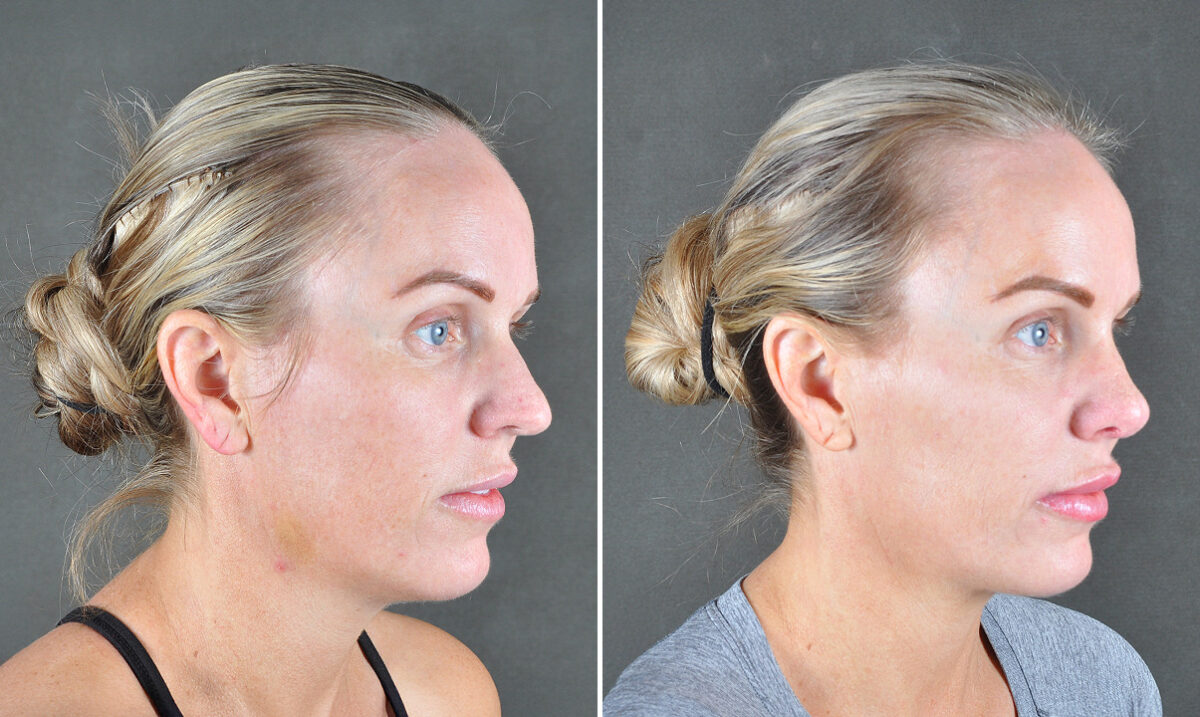 Case 22032, Rhinoplasty Before and After Photos Rhinoplasty Before and After Photos in Omaha, NE, Case 22032