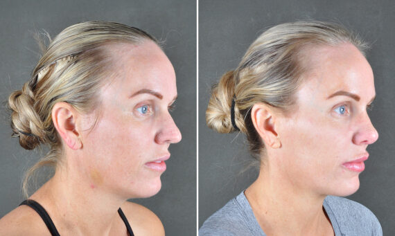 Rhinoplasty Before and After Photos in Omaha, NE, Case 22032