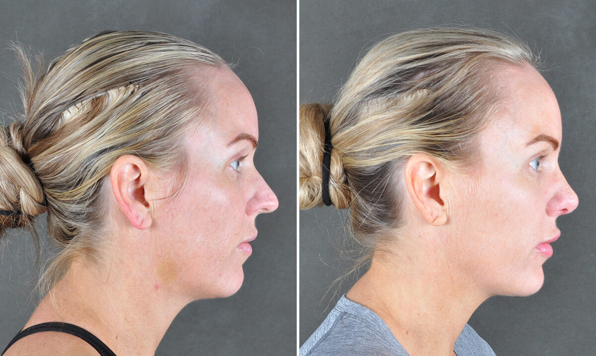 Case 22032, Rhinoplasty Before and After Photos Rhinoplasty Before and After Photos in Omaha, NE, Case 22032