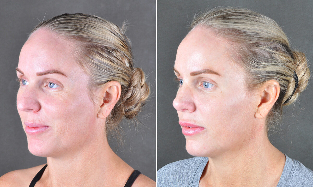 Case 22032, Rhinoplasty Before and After Photos Rhinoplasty Before and After Photos in Omaha, NE, Case 22032