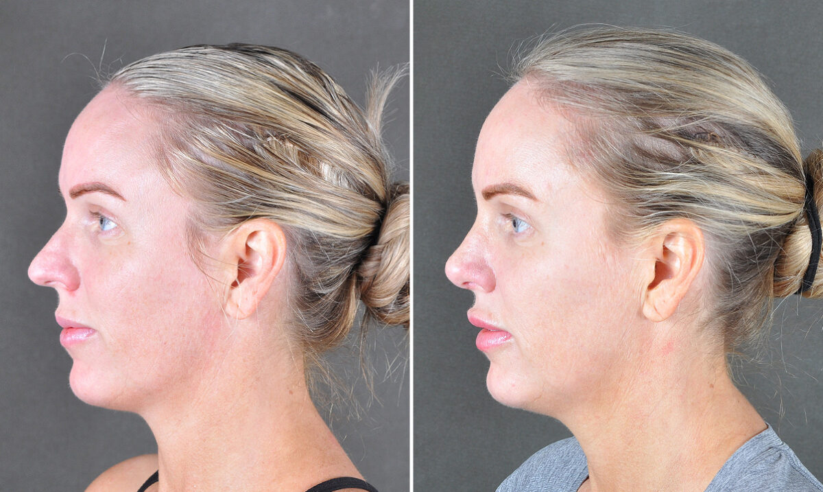 Case 22032, Rhinoplasty Before and After Photos Rhinoplasty Before and After Photos in Omaha, NE, Case 22032