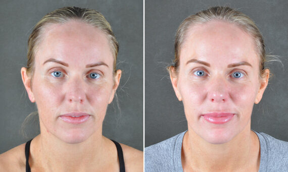 Rhinoplasty Before and After Photos in Omaha, NE, Case 22032