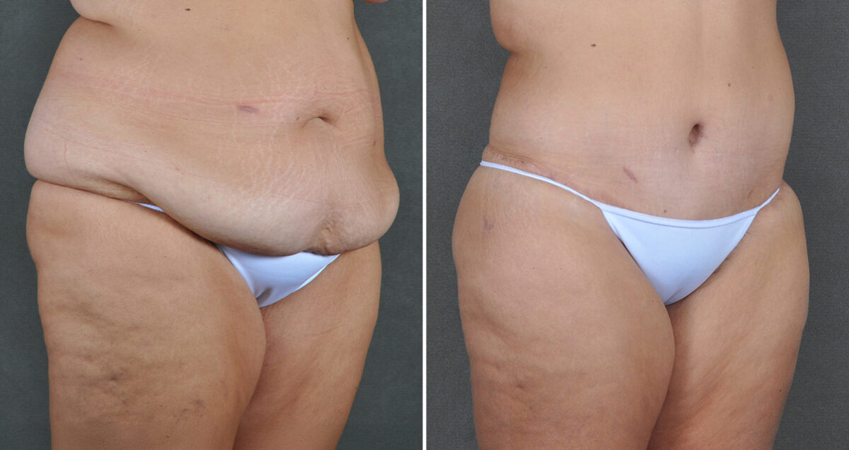 Case 22065, Tummy Tuck Before and After Photos Tummy Tuck Before and After Photos in Omaha, NE, Case 22065