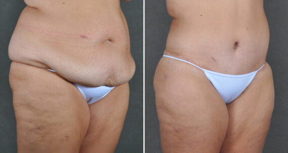 Tummy Tuck Before and After Photos in Omaha, NE, Case 22065