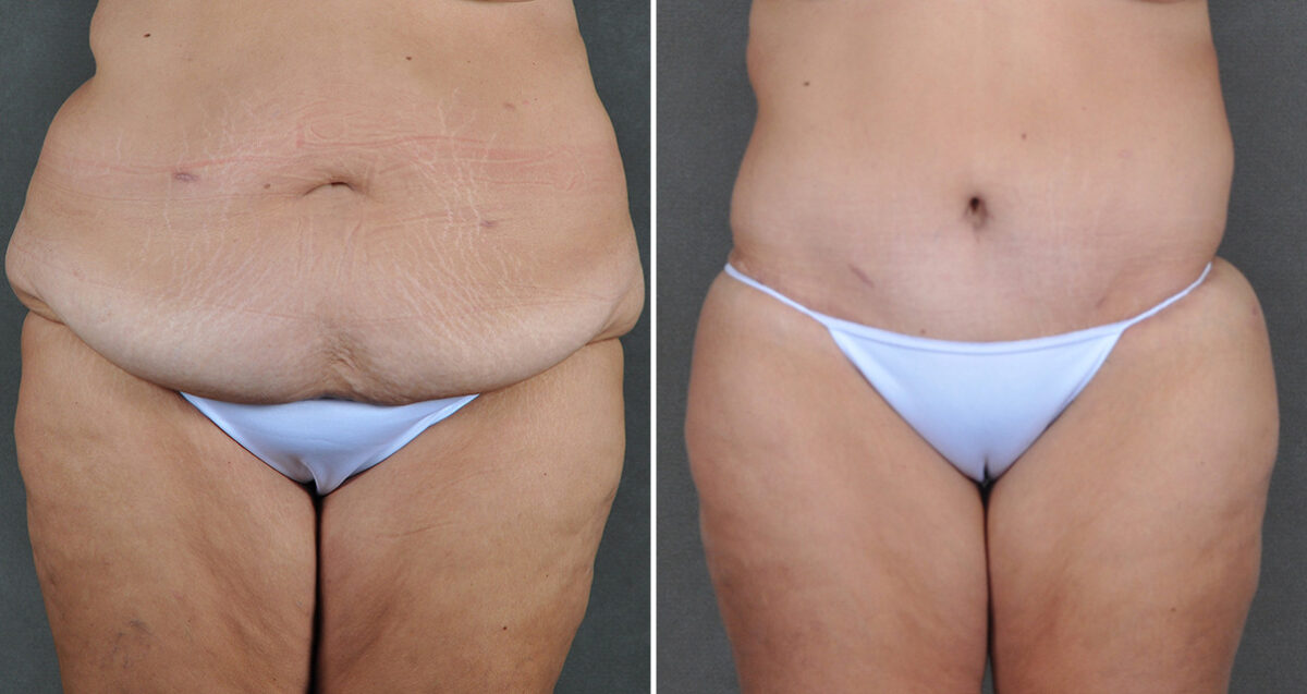 Case 22065, Tummy Tuck Before and After Photos Tummy Tuck Before and After Photos in Omaha, NE, Case 22065